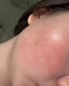 千草本原去除紅血絲修復臉部角質(zhì)層薄皮膚屏障受損敏感肌大紅臉?lè )杭t醫用膏 特效專(zhuān)用:臉部泛紅發(fā)燙(一盒) 曬單實(shí)拍圖