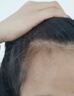 麗多麗亞生發(fā)液米諾地爾生發(fā)防脫發(fā)養(yǎng)發(fā)藥男女嚴(yán)重脂溢性脫發(fā)防脫激活毛囊 特效 買五贈(zèng)四(頭發(fā)在掉全退） 曬單實(shí)拍圖