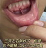口腔黏膜纖維化修復液檳榔護理液白斑潰瘍舌頭口腔潰爛抑菌噴霧液 檳榔口腔纖維化修復尖銳濕效噴劑 曬單實拍圖