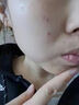點(diǎn)痣點(diǎn)斑后痘印痘坑修復(fù)精華液去斑紅黑印反黑美容院用修護(hù)保養(yǎng)液 曬單實(shí)拍圖