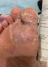 楊四郎腳醫(yī)生止尤凈雞眼貼膏瘊膏貼刺猴手足部肉刺瘊子去尤靈包扎款 曬單實(shí)拍圖