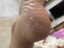 腳氣噴霧劑治嚴重腳氣藥止癢脫皮爛腳丫真菌感染治腳氣特藥皮膚用藥腳趾縫爛癢水泡鹽酸特比萘芬噴霧劑 3瓶【腳真菌感染 反復腳氣 對癥治療】藥師推薦 國藥正品 藥房直發(fā)-腳氣噴劑-角化型干裂腳氣藥 曬單實(shí)拍圖