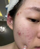 淋巴痘腮邊痘下巴長(cháng)痘痘祛痘藥膏硬塊痘反復長(cháng)痘結節玫瑰痤瘡專(zhuān)用排毒脖子額頭臉頰兩邊痤瘡紅腫消炎軟化痘痘 淋巴痘腮邊痘消炎軟化祛痘膏 曬單實(shí)拍圖
