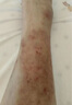 同仁堂醫(yī)用濕疹止癢膏 皮膚皮炎肛門瘙癢皮癬真菌感染陰囊潮濕修復凝膠 曬單實拍圖