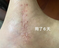 HIRUDOID泰國進(jìn)口疤痕修復(fù)膏剖腹產(chǎn)燒燙傷疤痕凝膠膏祛痘印術(shù)后皮膚修復(fù) hirudoid(舊疤 深疤痕）藍(lán)色40g 曬單實(shí)拍圖