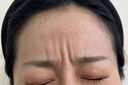EDRI川字紋貼抬頭紋去除神器男重度額頭皺紋睡覺(jué)貼提拉緊致抗皺女專(zhuān)用 曬單實(shí)拍圖