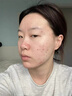 維特絲祛痘藥膏50g壬二酸水楊酸去痘痘和收毛孔閉口粉刺男女精華 曬單實拍圖
