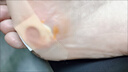 武毌制藥日本雞眼貼膏去腳底手上根肉刺老繭專用腳釘祛除雞繭跖手足部藥 雞眼貼8貼/盒 曬單實拍圖