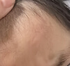 倍舒痕原裝進(jìn)口Dermatix醫(yī)用硅凝膠祛疤膏 溫和祛疤修復(fù)兒童適用15g 曬單實(shí)拍圖