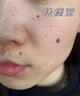 南京同仁堂醫用去痣點(diǎn)痣膏可搭配專(zhuān)用黑痣臉部不留疤專(zhuān)淡化黑色素藥 痣少-小痣-雀斑適用1盒裝 曬單實(shí)拍圖