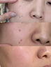 FLYMAN點(diǎn)痣膏水疤痕修復(fù)去痣點(diǎn)痣膏點(diǎn)疣水醫(yī)用專用(非藥)官方正品祛痣膏 套裝一:【點(diǎn)痣+修復(fù)】一盒 (100%發(fā)貨特效快)美容院專用不留疤不留坑 曬單實(shí)拍圖