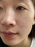 dyey點痣膏無痕去痣黑痣瘊子點痣液扁平尤絲狀尤尖尤肉刺肉兒童可用 曬單實拍圖