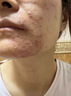 克林霉素甲硝唑搽劑臉上痘痘消炎藥祛痘藥膏醫(yī)用祛痘消炎痤瘡硬疙瘩專用藥青少年粉刺膿皰痤瘡硬疙瘩皮膚用藥 2盒【痘痘粉刺痤瘡專用藥】藥師力薦 臉上反復(fù)冒痘-額頭長痘痘痤瘡粉刺硬疙瘩 曬單實拍圖