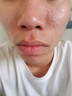 藤石制藥醫(yī)用痘印痘坑修復(fù)凹洞凝膠祛痘印修復(fù)淡化痘印溫和閉口舒緩痘疤HB 送棉簽【買二送一】周期裝大部分用戶選擇 曬單實拍圖