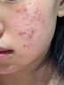 復方珍珠暗瘡片痤瘡專(zhuān)用藥女性去粉刺濕疹修復瘙癢面部紅斑丘疹性濕疹清熱解毒涼血消斑反復長(cháng)紅腫痤瘡痘痘 3盒裝【油脂堵塞粉刺膿皰】 曬單實(shí)拍圖