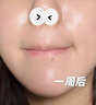 透真控油祛痘水乳套裝茶樹油修復(fù)痘印收縮毛孔補(bǔ)水爽膚水青少年護(hù)膚品 曬單實(shí)拍圖