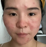 藤石制藥醫(yī)用玫瑰痤瘡專用修復(fù)凝膠皮膚屏障受損敏感肌泛紅面霜護(hù)膚品膏XT 1盒試用裝【醫(yī)用玫瑰痤瘡修復(fù)凝膠】不滿意可退款 曬單實(shí)拍圖