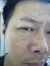 維A酸乳膏去疣體特新效期藥扁平疣專用藥去疣類藥膏去脖子小肉粒頸部瘊子去尤瘊小肉粒去疣膏瘊子肉刺肉粒 1盒裝【國藥準(zhǔn)字脫疣瘊】 瘊子去除國藥準(zhǔn)字藥膏  放心購買 安心售后 曬單實拍圖