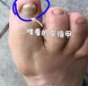 李修臺(tái)山李修 灰指甲抑菌液增厚發(fā)黃腳趾甲草本hj 買二贈(zèng)一（三盒 療程裝) 曬單實(shí)拍圖