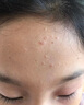 FALRUIER去疣體100%特藥扁平疣專用除絲狀疣私處尖銳濕疣脫落瘊子祛疣膏 一盒裝【去疣不留痕】 扁平疣尖銳濕疣脖子頸部絲狀疣小肉粒跖疣瘊子進口配方 曬單實拍圖
