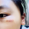 華美科醫(yī)用重組人體表皮生長因子點痣疤痕修復凝膠燙軟膏傷口愈合15g1支 曬單實拍圖