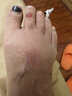 川廿制藥日本狼毒腳氣噴霧劑克星軟膏止癢脫皮爛腳丫真菌感染治腳氣腳臭 曬單實(shí)拍圖