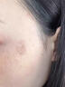 妍膚美白祛斑霜祛斑老年黃褐斑雀斑曬斑男女士去斑去黑色素醫(yī)用正品 醫(yī)用膏 20g 1盒【當(dāng)晚祛斑不留痕】 377+577臉部手背專用霜去老人斑 曬單實(shí)拍圖