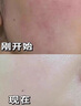 蘆薈凝膠醫用消炎止癢[同仁堂品質(zhì)]蘆薈膠凝膠醫用級冷敷燒傷燙傷叮咬抗菌消炎曬后補水修復皮膚止癢 3支 周期裝 曬單實(shí)拍圖