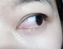 鄒潤安胬肉眼藥水眼睛去胬肉翼狀胬肉緩解異物感眼疲勞眼干眼澀滴眼液 買二送一【消除胬肉】 曬單實拍圖