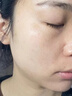 維特絲壬二酸祛痘藥膏去痘痘粉刺閉口收縮毛孔男女煙酰胺水楊酸 曬單實(shí)拍圖