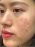維特絲祛痘藥膏50g壬二酸水楊酸去痘痘和收毛孔閉口粉刺男女精華 曬單實(shí)拍圖