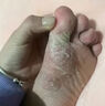 達克寧腳氣藥止癢脫皮爛腳丫真菌感染治腳氣達克寧硝酸咪康唑乳膏腳臭腳氣藥止癢真菌感染皮膚用藥 非處方藥 2盒【硝酸咪康唑乳膏】癢的受不了 老是摳腳 達克寧腳氣藥止癢脫皮爛腳丫真菌感染治腳氣 曬單實拍圖
