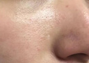 碧素堂（BISUTANG）青春痘面霜祛痘膏男學生修護淡化痘痘印青少年去痘痘正品女初中生 150g 3盒（中度痘肌推薦） 曬單實拍圖