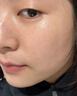 維特絲壬二酸祛痘藥膏去痘痘粉刺閉口收毛孔男女煙酰胺水楊酸青少年凝膠 曬單實拍圖