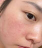 醫(yī)用冷敷貼面膜型械字號(hào)透明質(zhì)酸鈉修復(fù)貼敷料醫(yī)美術(shù)后消炎去紅美白補(bǔ)水曬后修復(fù)收縮毛孔祛痘控油淡化痘印 曬單實(shí)拍圖
