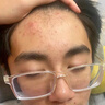 SUMDOY日本進口祛痘印痘坑修復膏去痘紅腫淡化痘印疤蘆薈膠女士男士祛痘 2支祛痘修復膏30ML 曬單實拍圖