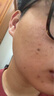 甲硝唑凝膠+15%壬二酸+阿達(dá)帕林+水楊酸組合cp改善痘痘黑頭粉刺甲硝銼凝膠和任二酸醫(yī)用凝膠 1盒+1盒阿達(dá)帕林帕寧【治療青春痘膿包外用藥 曬單實(shí)拍圖