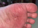 名村孕婦腳氣專用的哺乳期孕期止癢脫皮殺菌去腳臭藥膏噴劑水泡名村XR 【孕期哺乳期可用】抑菌膏1瓶（送棉簽） 曬單實(shí)拍圖