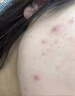 Newliann醫(yī)用祛痘貼去痘痘和痘印消炎吸膿隱形修復(fù)膏淡化痘坑痤瘡專用制藥 曬單實拍圖
