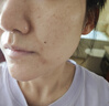 博樂達(dá)【醫(yī)院源碼版本】30%濃度水楊酸去角質(zhì)閉口粉刺收縮毛孔提亮膚色 30%博樂達(dá)水楊酸源碼+護(hù)理包源碼 7g 曬單實(shí)拍圖