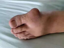 進(jìn)口痛風(fēng)藥貼膏貼溶石結(jié)晶溶解降尿酸高關(guān)節(jié)腫脹疼痛專用冷敷凝膠 特i效1盒【泰國透骨膏】 治療日本原裝進(jìn)口貼消炎消腫止痛 曬單實(shí)拍圖