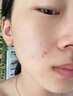 維特絲壬二酸祛痘藥膏去痘痘粉刺閉口收毛孔男女煙酰胺水楊酸青少年凝膠 曬單實(shí)拍圖