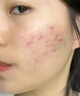 OHBT祛痘膏60g青春痘閉孔粉刺收縮毛孔專用學(xué)生男女凝膠男士化妝品 曬單實拍圖