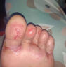 HERZFELD德國(guó)狼毒腳氣噴霧止癢脫皮爛腳丫真菌感染腳臭腳出汗水泡腳氣噴劑 二盒裝【止癢腳臭脫皮】專用 曬單實(shí)拍圖