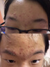 老中醫(yī)祛痘精華修護(hù)素30g 男女士祛痘霜淡化痘印痘坑去青春痘粉刺祛痘膏 曬單實(shí)拍圖