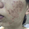 白樺依然祛痘膏美白去痘痘和痘印修復(fù)初高中生男女學(xué)生閉口粉刺青春痘30g 3瓶療程裝 【立省40】 曬單實拍圖