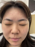 維特絲祛痘藥膏50g壬二酸水楊酸去痘痘和收毛孔閉口粉刺男女精華 曬單實(shí)拍圖