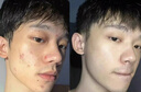 維特絲祛痘藥膏50g壬二酸水楊酸去痘痘和收毛孔閉口粉刺男女精華 曬單實(shí)拍圖