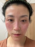 醫(yī)用冷敷貼面膜型械字號透明質酸鈉修復貼敷料醫(yī)美術后消炎去紅美白補水曬后修復收縮毛孔祛痘控油淡化痘印 曬單實拍圖