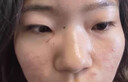 XIBELAON德國醫(yī)用疤痕貼增生凸起去除疙瘩燒燙傷剖腹產(chǎn)手術(shù)兒童減張祛疤膏 3盒18貼【新舊祛疤痕貼】 曬單實拍圖